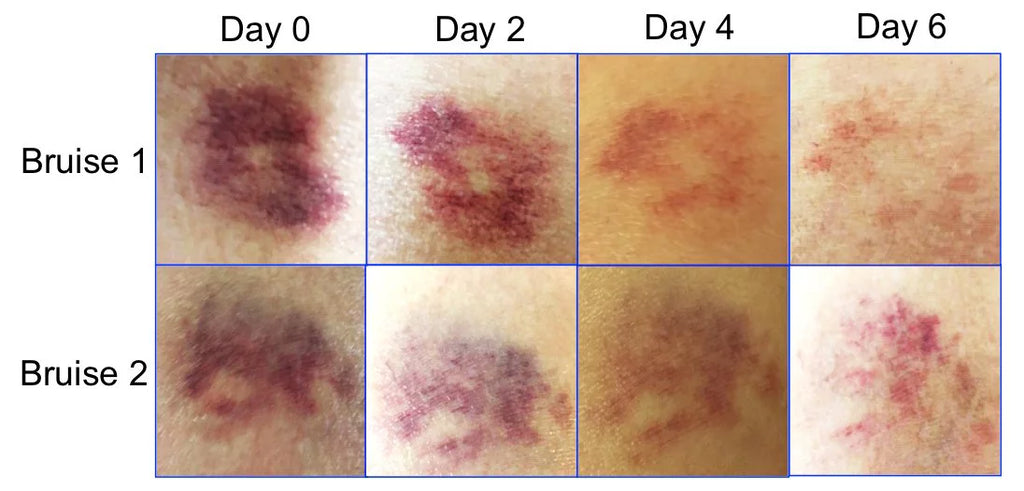 BruiseGONE 3 pack- Speeds bruise healing by ONE WEEK, NO CREAM, Natural bruise remedy